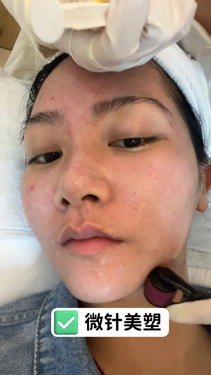 痤疮的图片是什么样子的